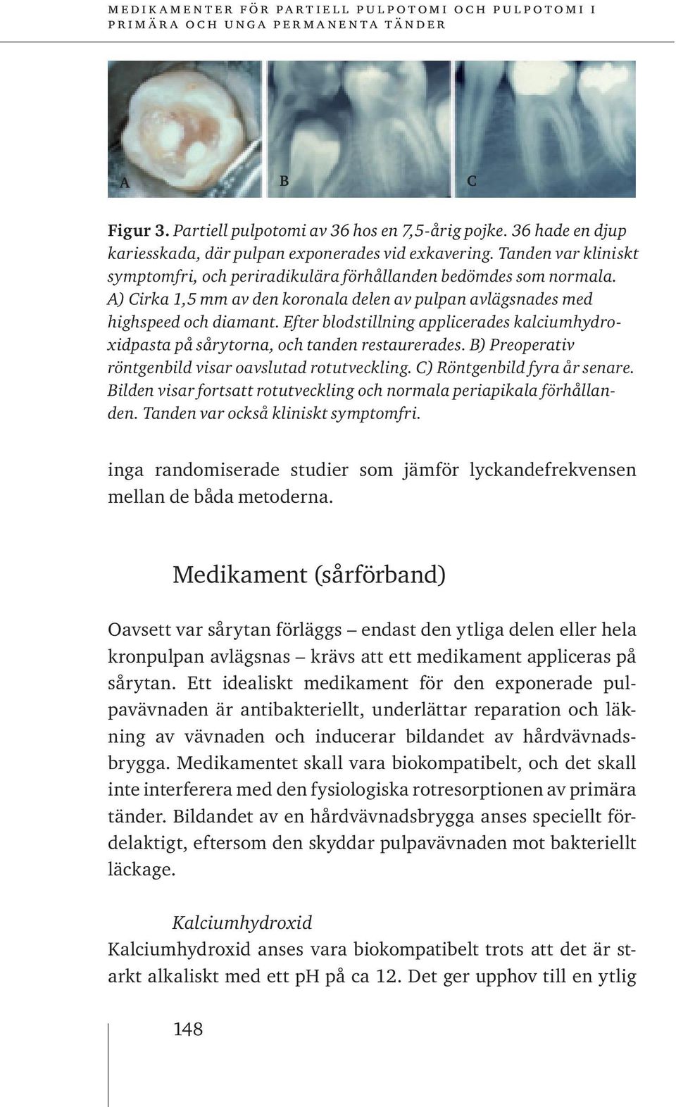 Efter blodstillning applicerades kalciumhydroxidpasta på sårytorna, och tanden restaurerades. B) Preoperativ röntgenbild visar oavslutad rotutveckling. C) Röntgenbild fyra år senare.