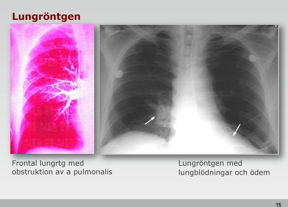 av a pulmonalis