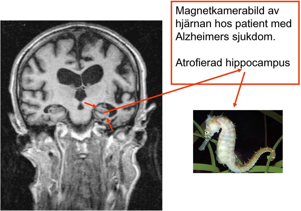 med Alzheimers