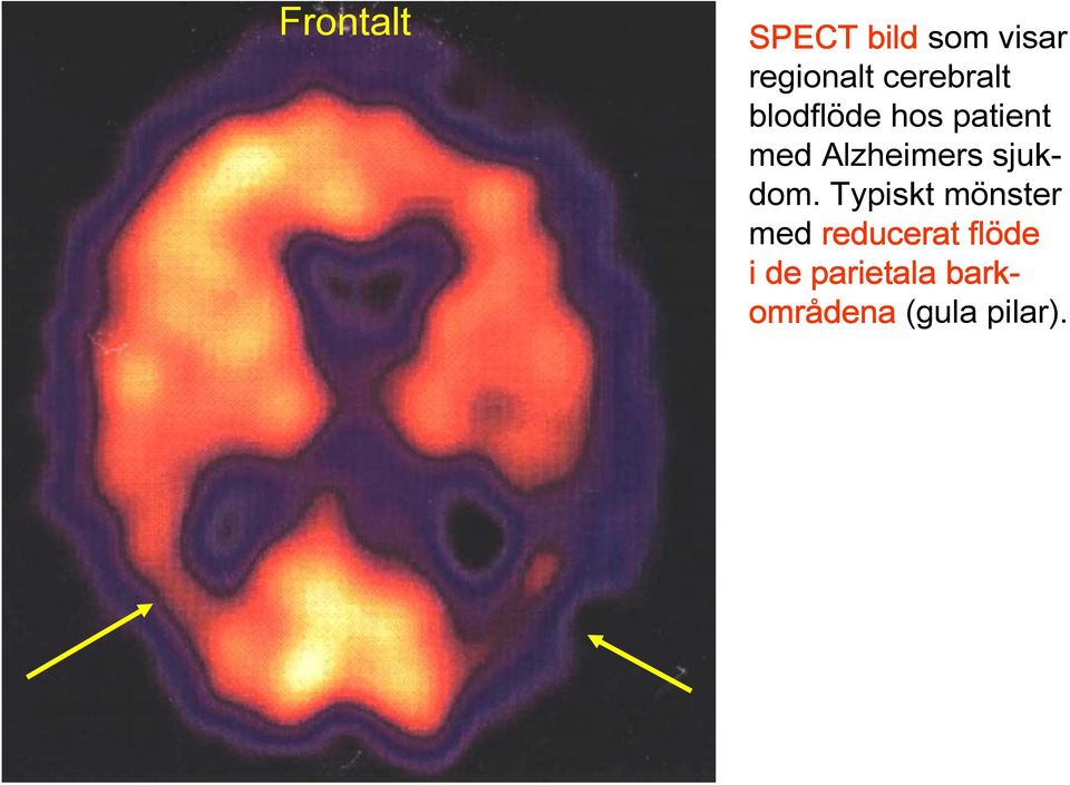 Alzheimers sjukdom.