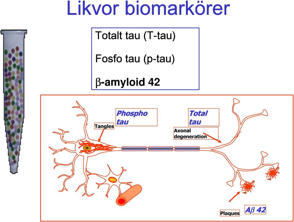 β-amyloid 42 Tangles Phospho tau