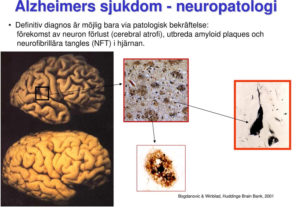 (cerebral atrofi), utbreda amyloid plaques och neurofibrillära