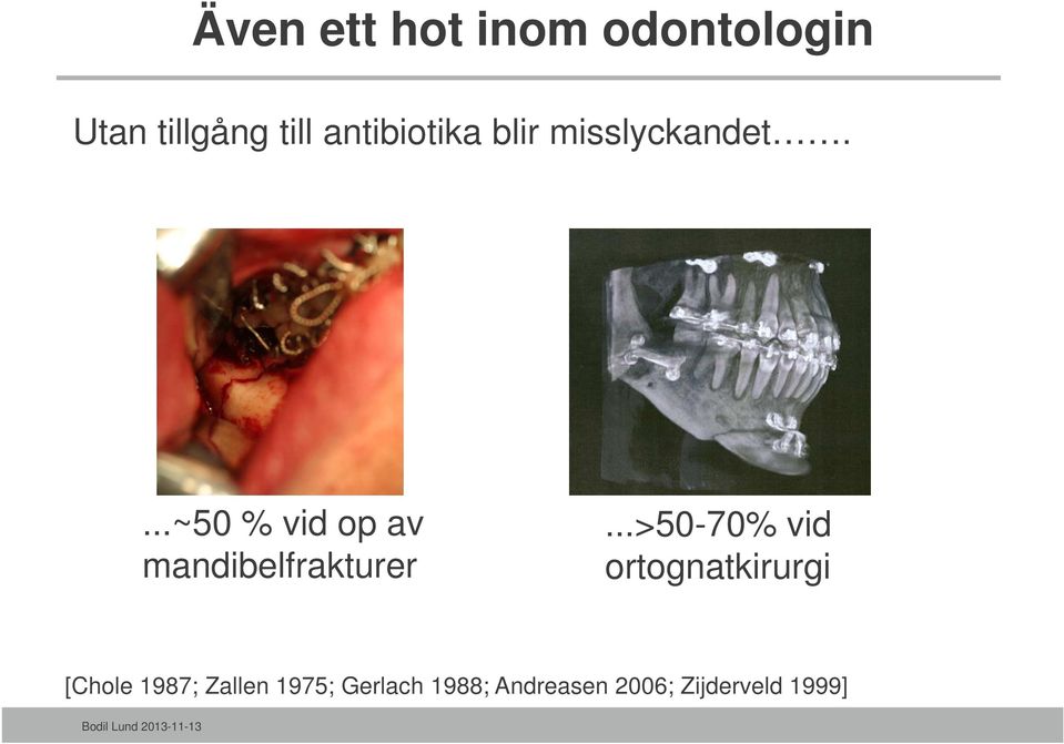 ...~50 % vid op av mandibelfrakturer.