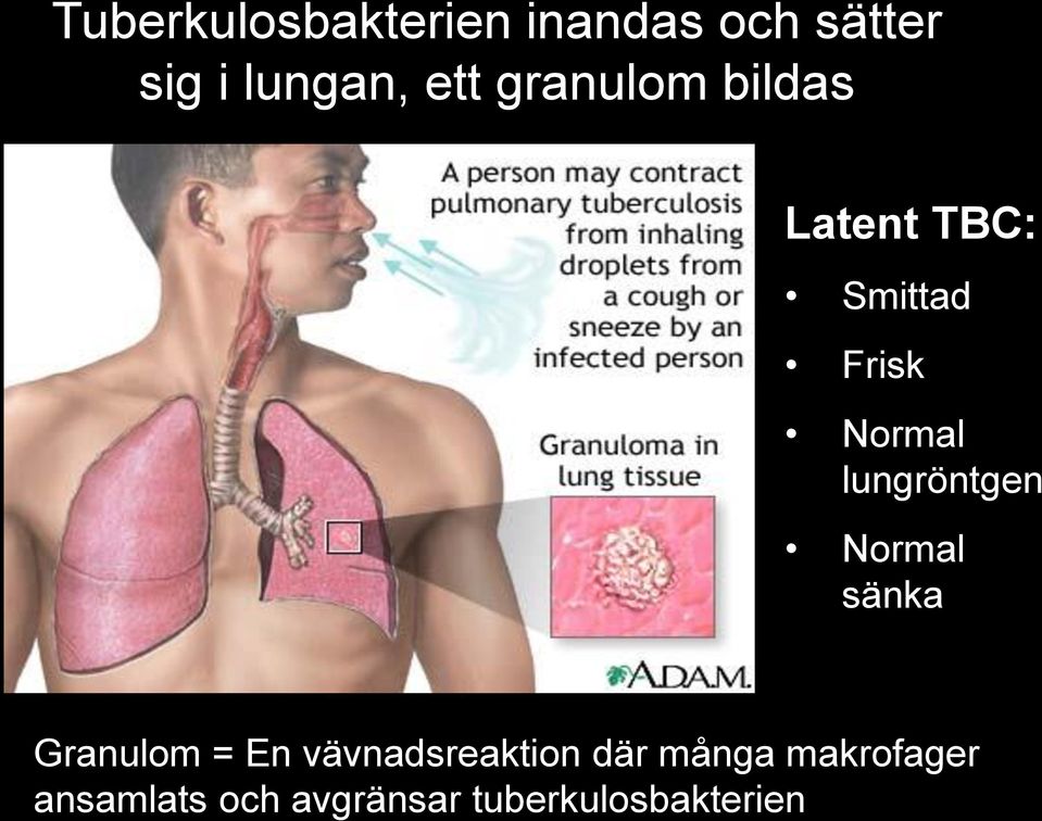 lungröntgen Normal sänka Granulom = En vävnadsreaktion