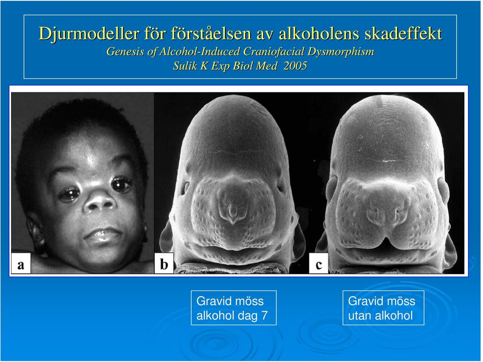 Alcohol-Induced Craniofacial Dysmorphism Sulik