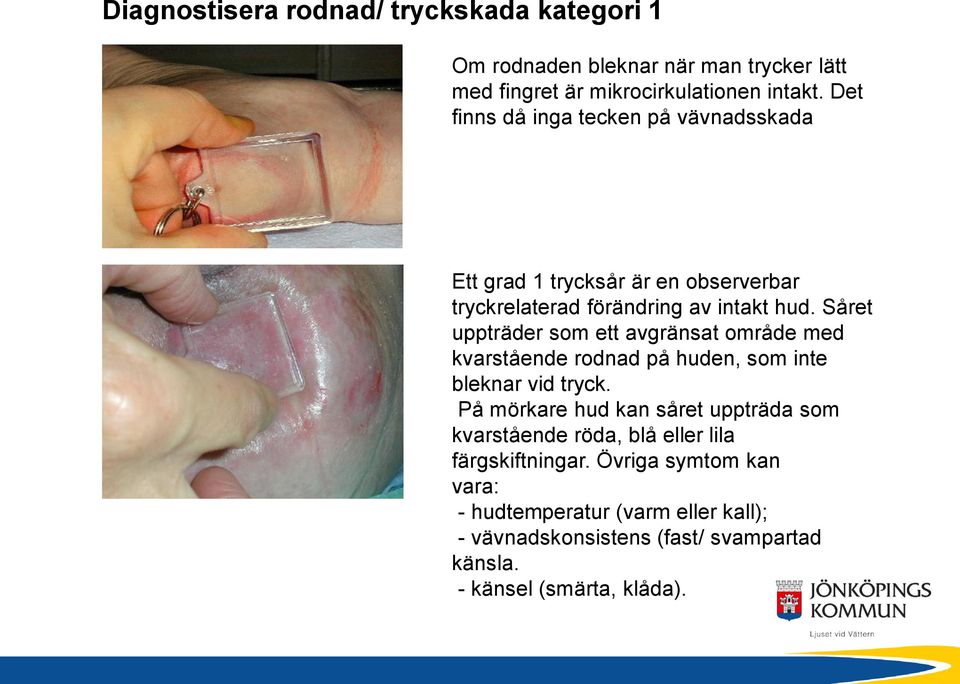 Såret uppträder som ett avgränsat område med kvarstående rodnad på huden, som inte bleknar vid tryck.