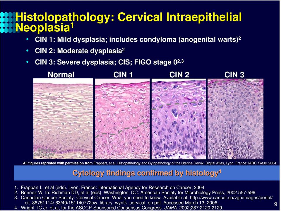 Cytology findings confirmed by histology 4 1. Frappart L, et al (eds). Lyon, France: International Agency for Research on Cancer; 2004. 2. Bonnez W. In: Richman DD, et al (eds).