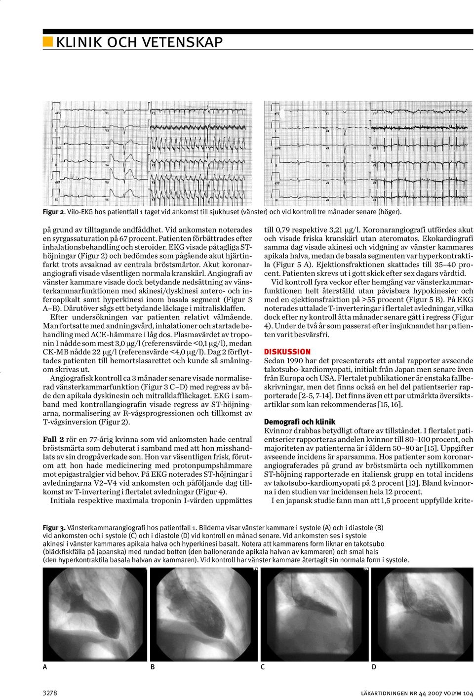 EKG visade påtagliga SThöjningar (Figur 2) och bedömdes som pågående akut hjärtinfarkt trots avsaknad av centrala bröstsmärtor. Akut koronarangiografi visade väsentligen normala kranskärl.
