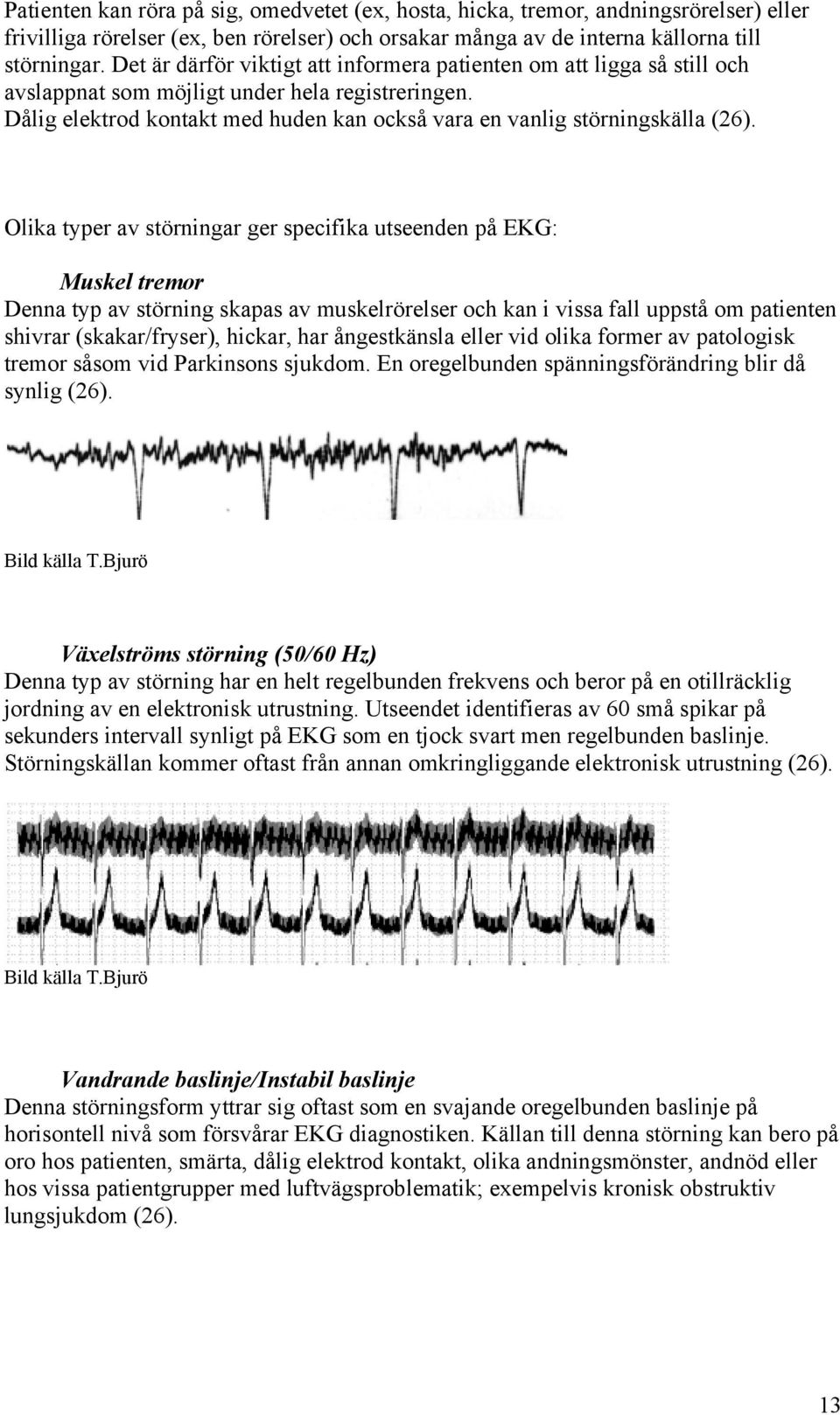 Olika typer av störningar ger specifika utseenden på EKG: Muskel tremor Denna typ av störning skapas av muskelrörelser och kan i vissa fall uppstå om patienten shivrar (skakar/fryser), hickar, har