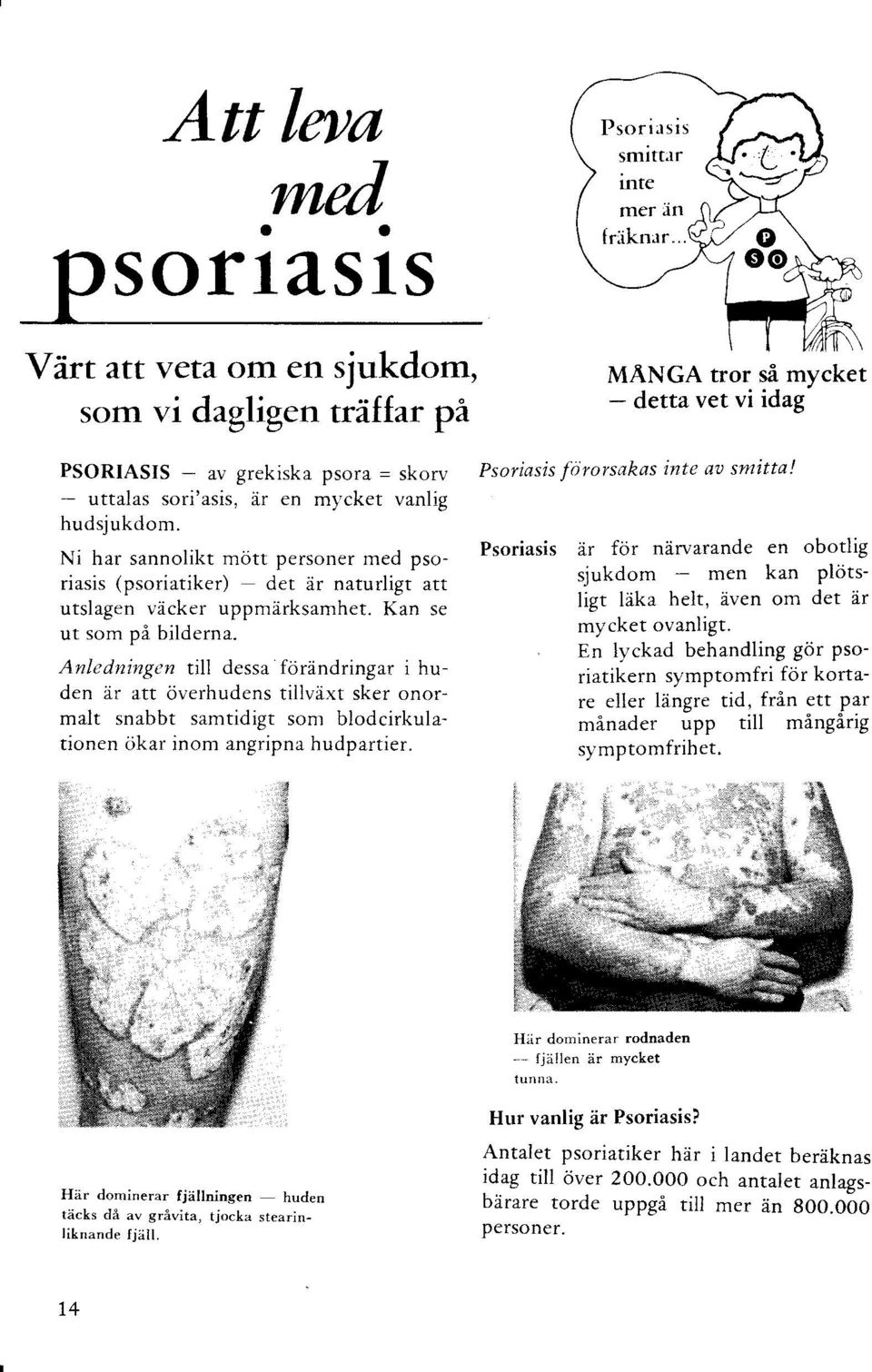 Anledningen till dessa förändringar i huden är att överhudens tillväxt sker onormalt snabbt samtidigt som blodcirkulationen ökar inom angripna hudpartier. Psoriasis smitter inte mer än f rikn:rr ".