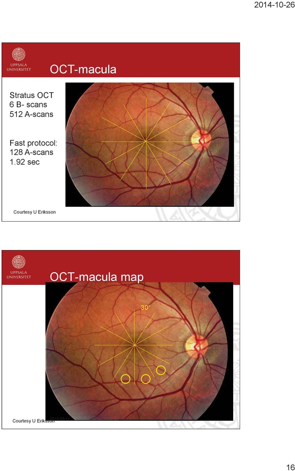 92 sec Courtesy U Eriksson OCT-macula