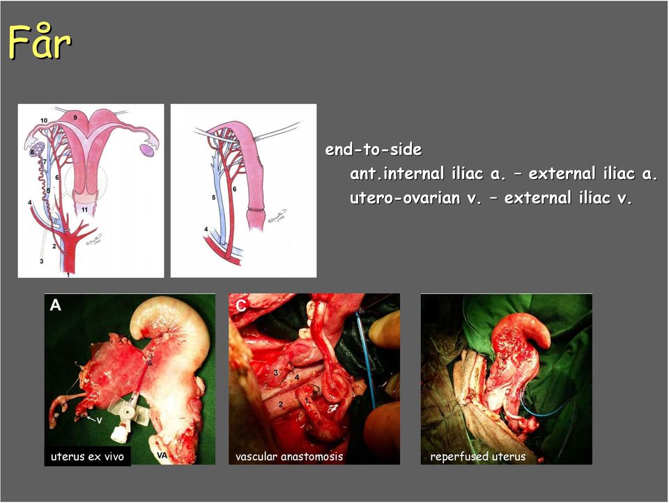 utero-ovarian ovarian v.