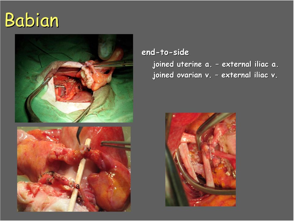 external iliac a.