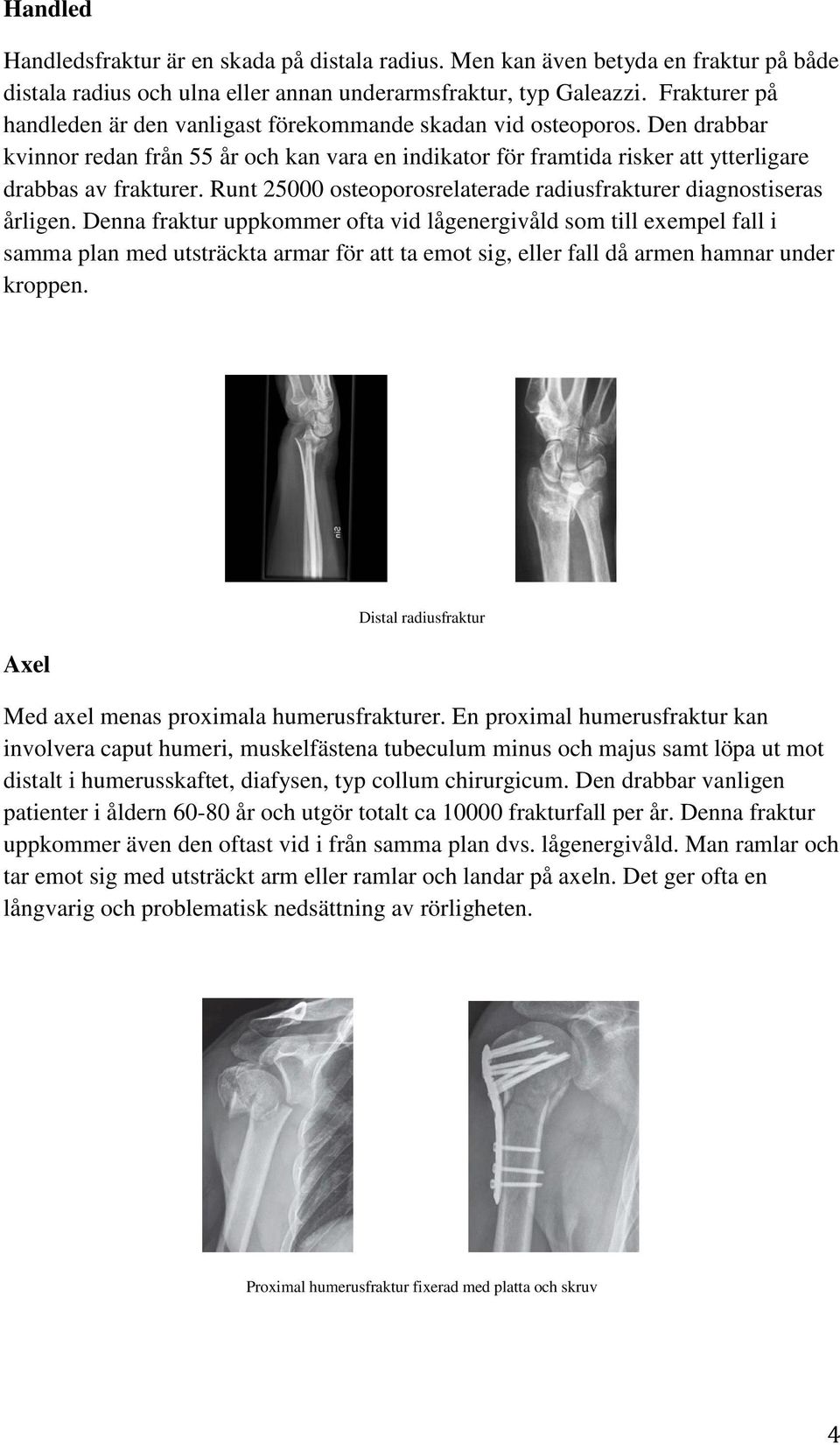 Runt 25000 osteoporosrelaterade radiusfrakturer diagnostiseras årligen.