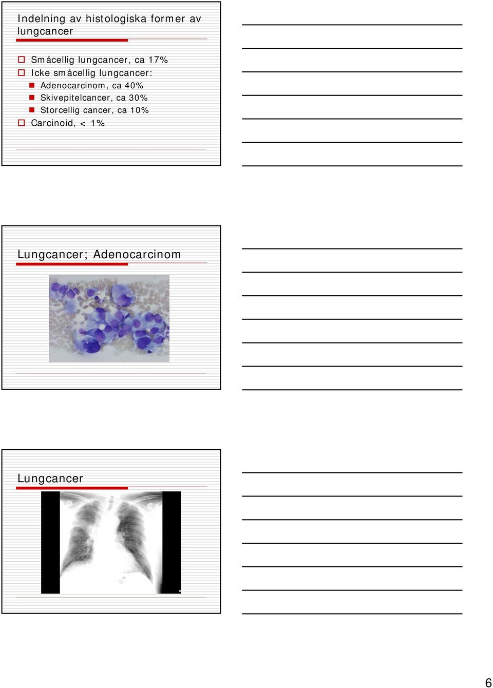 Adenocarcinom, ca 40% Skivepitelcancer, ca 30% Storcellig