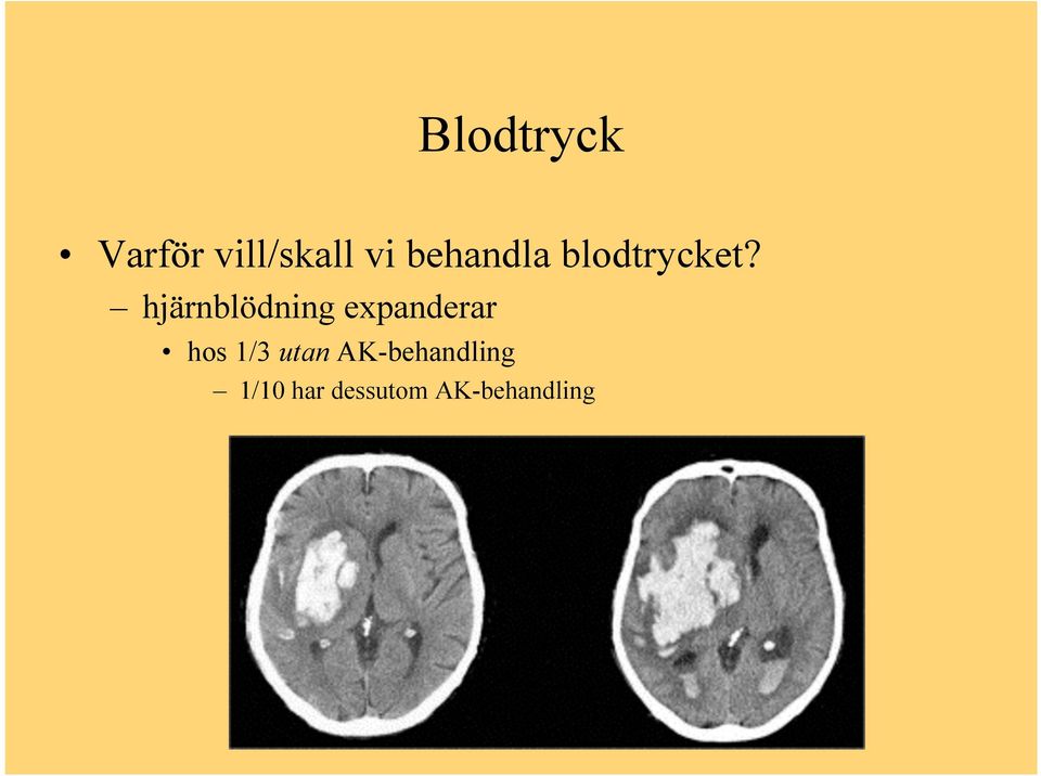 hjärnblödning expanderar hos 1/3