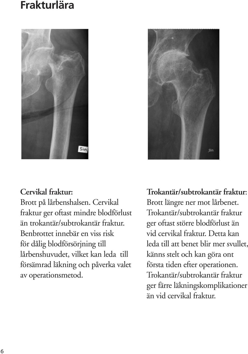 Trokantär/subtrokantär fraktur: Brott längre ner mot lårbenet. Trokantär/subtrokantär fraktur ger oftast större blodförlust än vid cervikal fraktur.