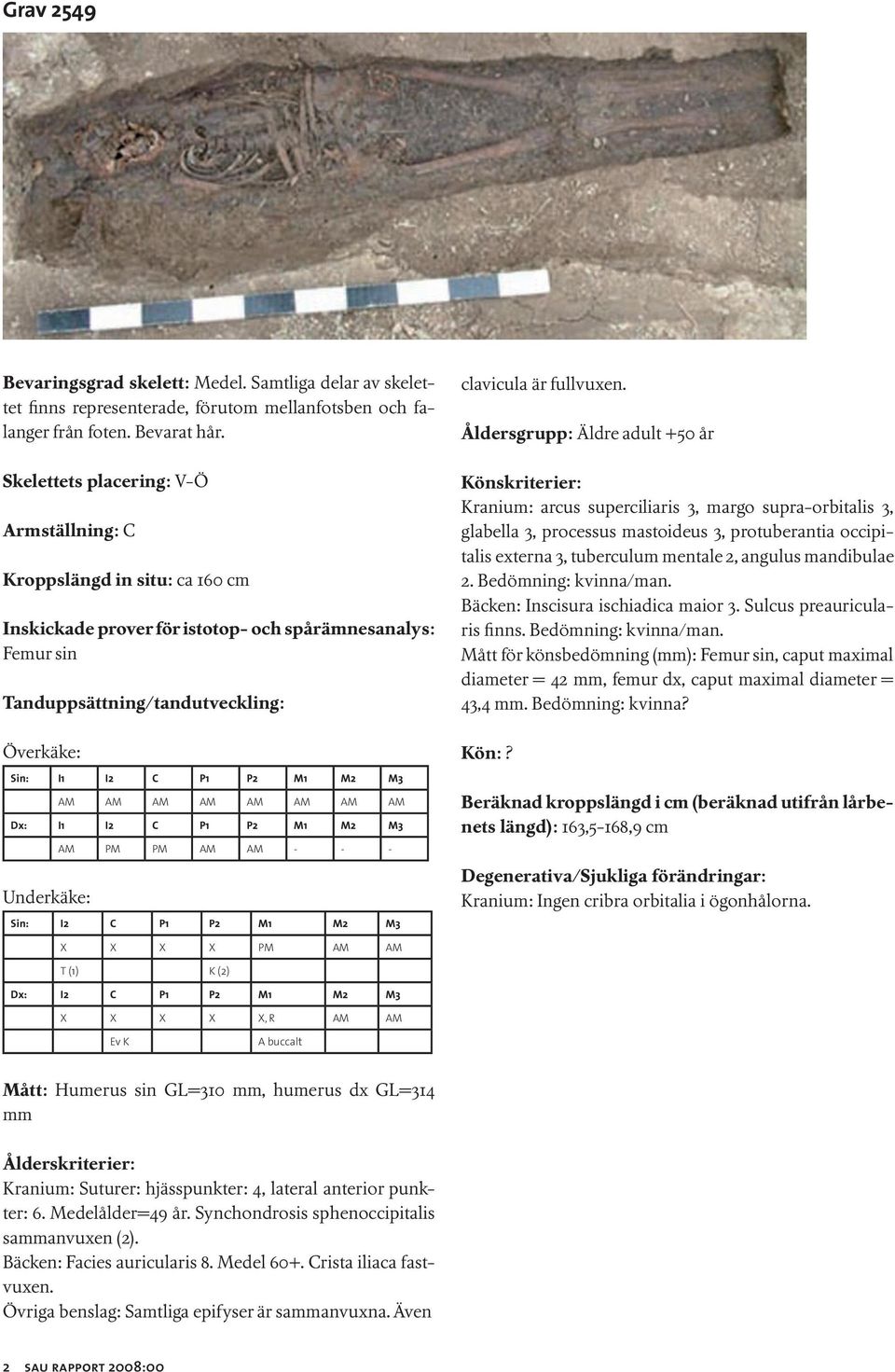 Åldersgrupp: Äldre adult +50 år Könskriterier: Kranium: arcus superciliaris 3, margo supra-orbitalis 3, glabella 3, processus mastoideus 3, protuberantia occipitalis externa 3, tuberculum mentale 2,