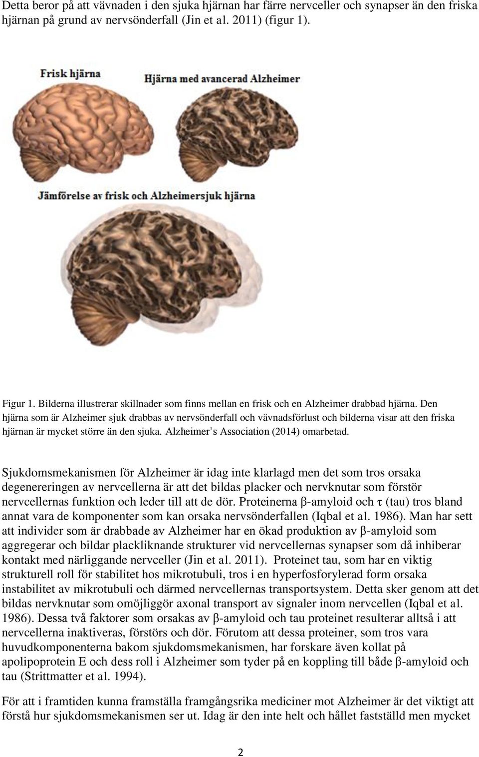 Den hjärna som är Alzheimer sjuk drabbas av nervsönderfall och vävnadsförlust och bilderna visar att den friska hjärnan är mycket större än den sjuka. Alzheimer s Association (2014) omarbetad.
