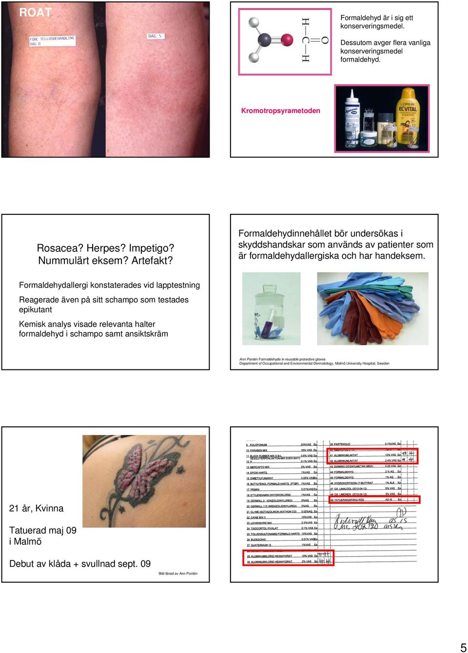 Formaldehydallergi konstaterades vid lapptestning Reagerade även på sitt schampo som testades epikutant Kemisk analys visade relevanta halter formaldehyd i schampo samt