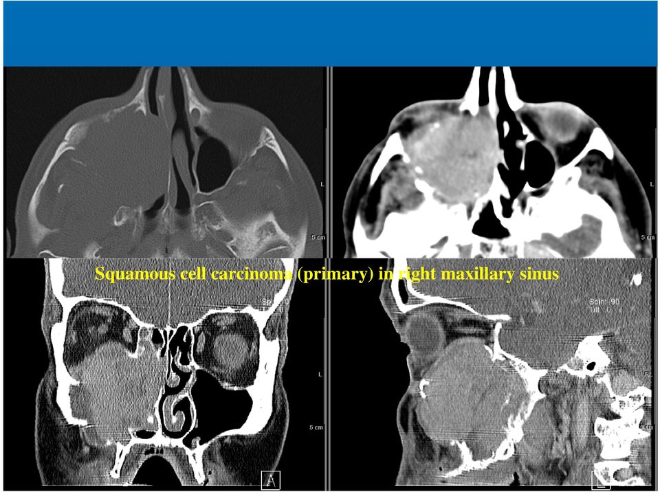 in right maxillary