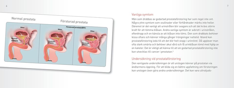 Andra vanliga symtom är avbrott i urinstrålen, efterdropp och en känsla av att blåsan inte töms. Den som drabbats behöver kissa oftare och känner många gånger trängningar nattetid.