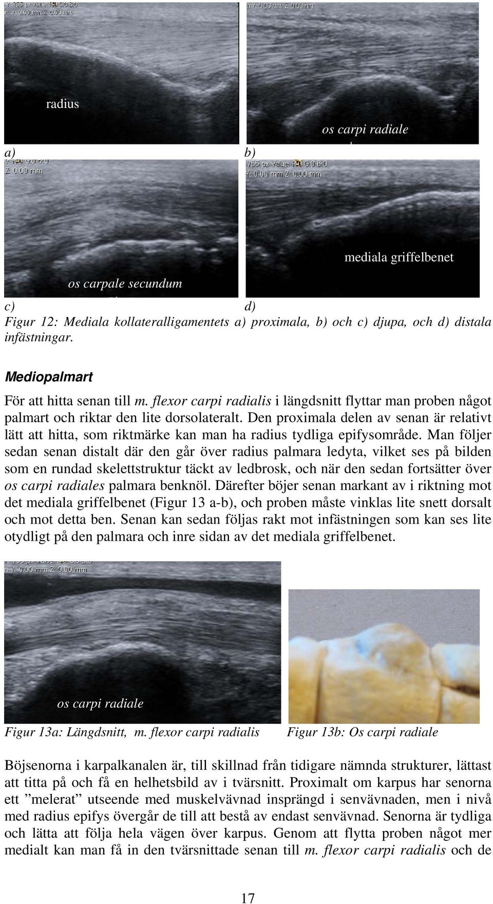 Den proximala delen av senan är relativt lätt att hitta, som riktmärke kan man ha radius tydliga epifysområde.