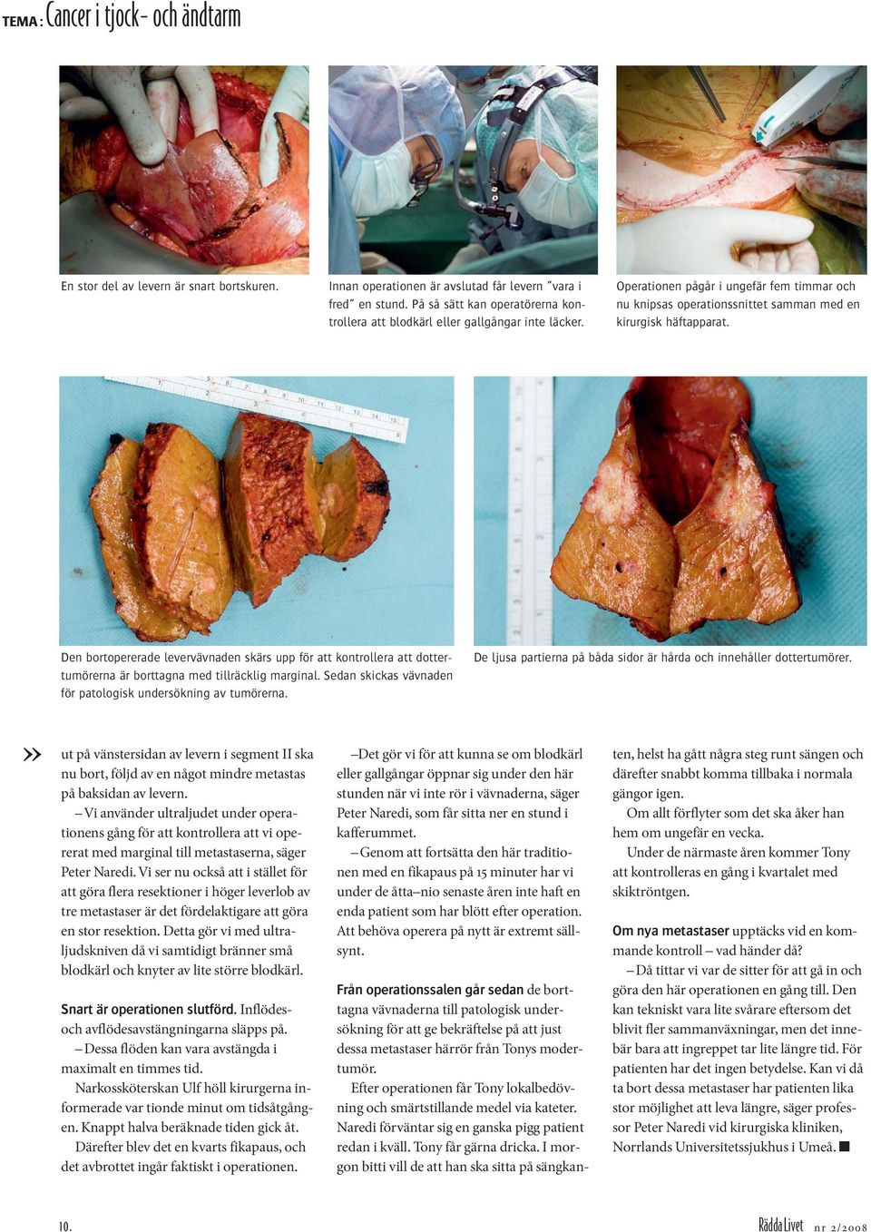 Den bortopererade levervävnaden skärs upp för att kontrollera att dottertumörerna är borttagna med tillräcklig marginal. Sedan skickas vävnaden för patologisk undersökning av tumörerna.