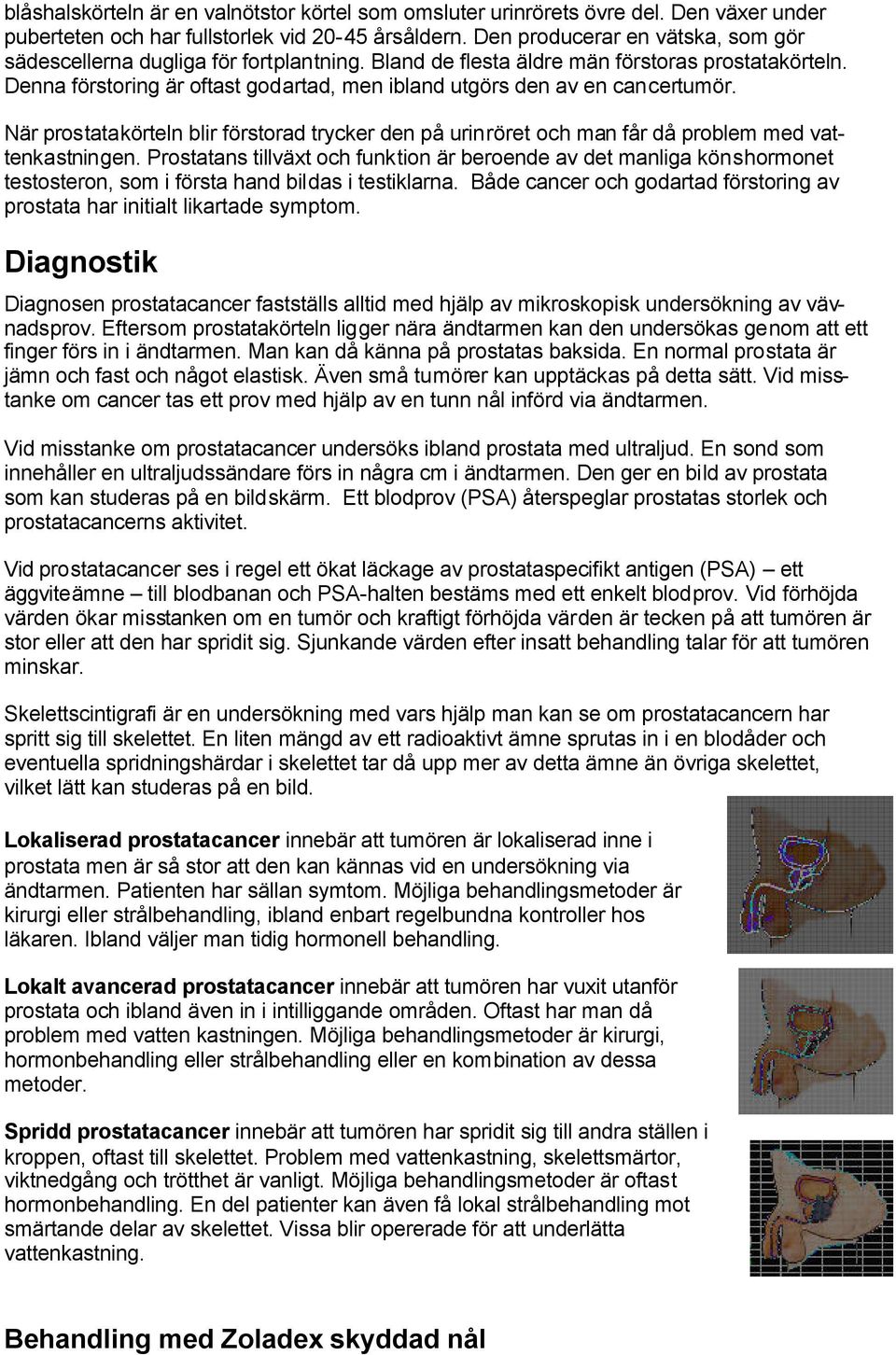 Denna förstoring är oftast godartad, men ibland utgörs den av en cancertumör. När prostatakörteln blir förstorad trycker den på urinröret och man får då problem med vattenkastningen.