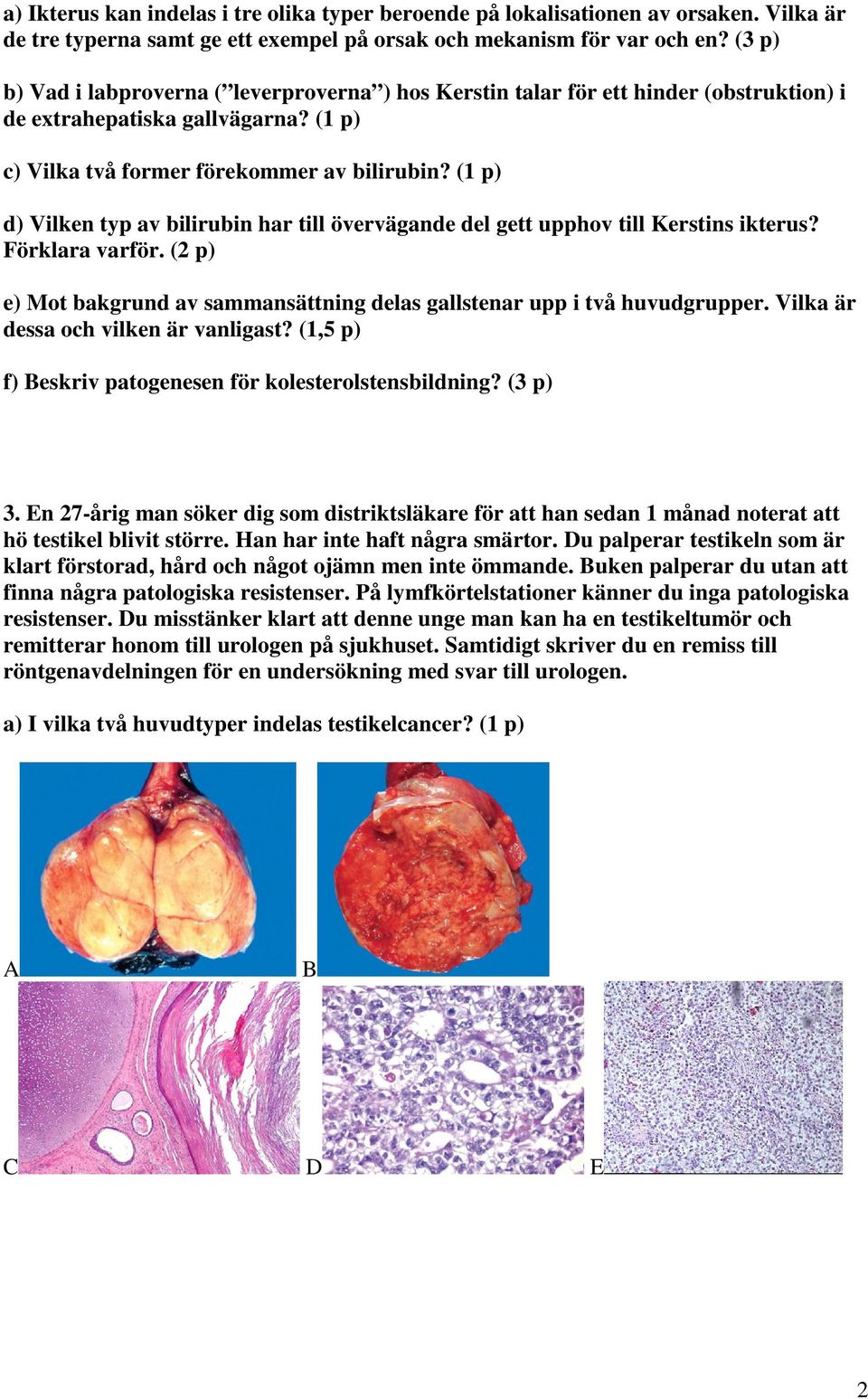 (1 p) d) Vilken typ av bilirubin har till övervägande del gett upphov till Kerstins ikterus? Förklara varför. (2 p) e) Mot bakgrund av sammansättning delas gallstenar upp i två huvudgrupper.