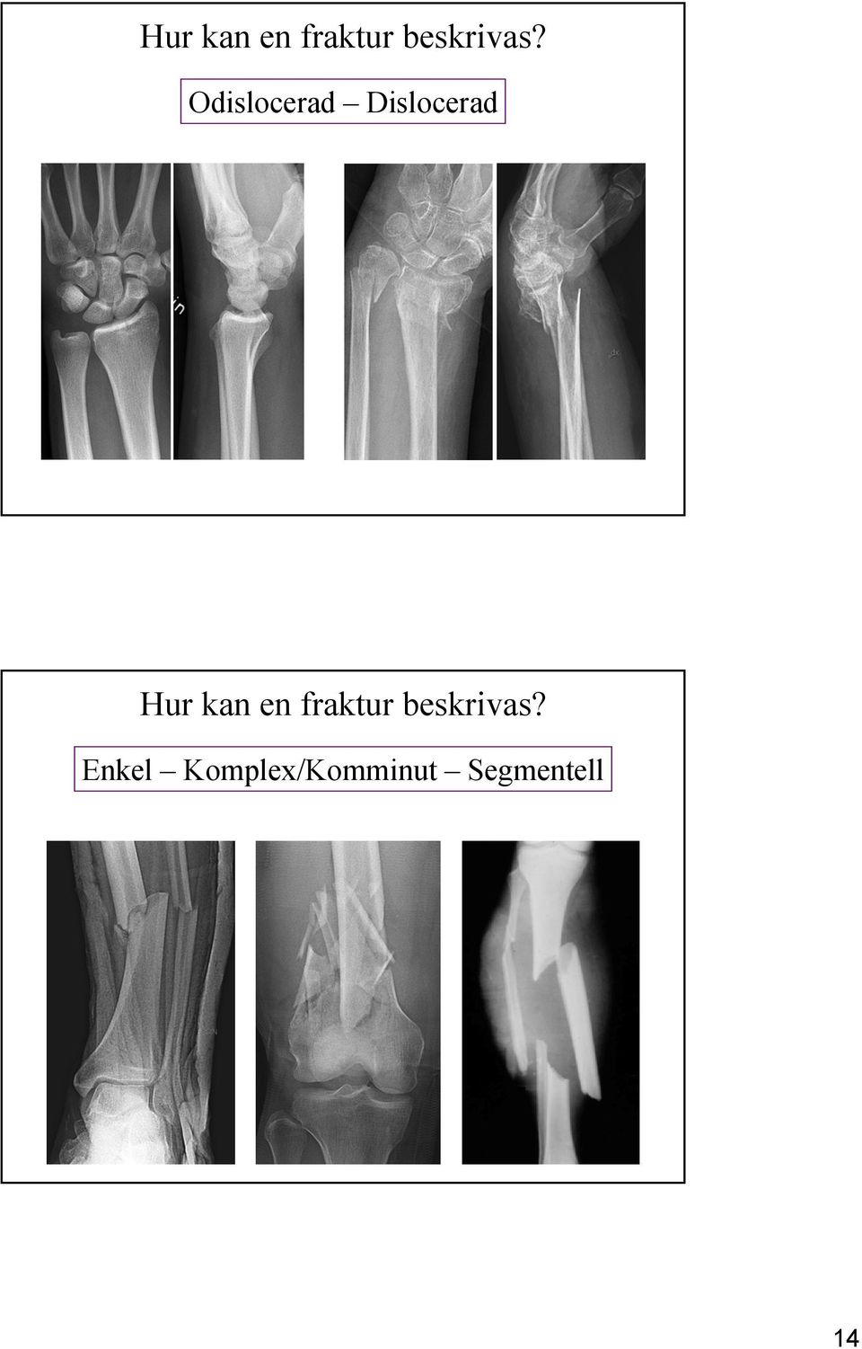 Komplex/Komminut Segmentell