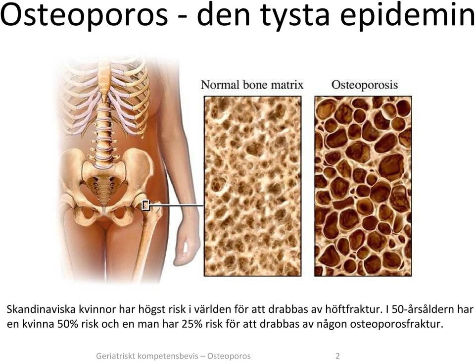 I 50 årsåldern har en kvinna 50% risk och en man har 25% risk