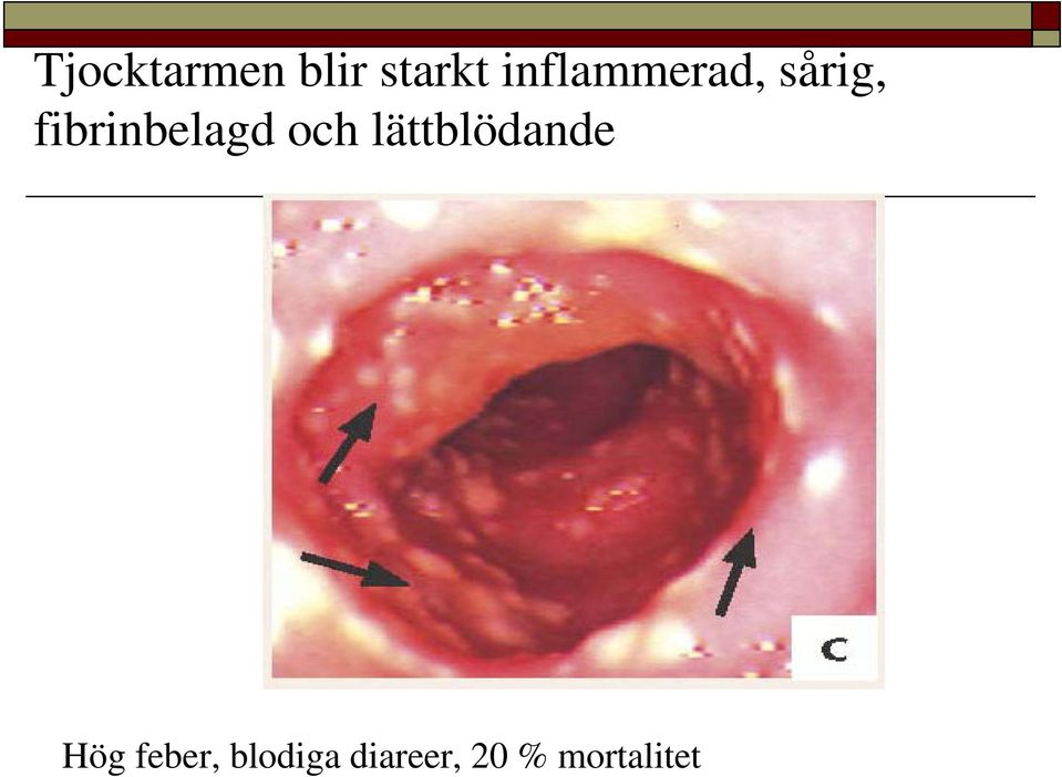 fibrinbelagd och lättblödande