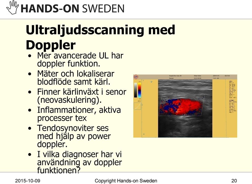 Finner kärlinväxt i senor (neovaskulering).