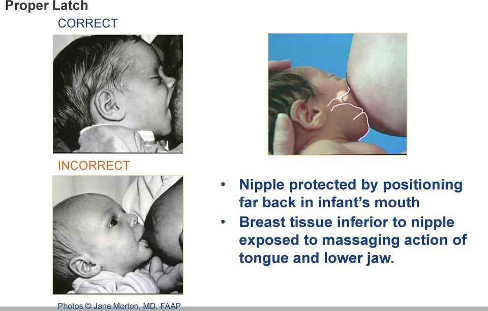 tissue inferior to nipple exposed to massaging