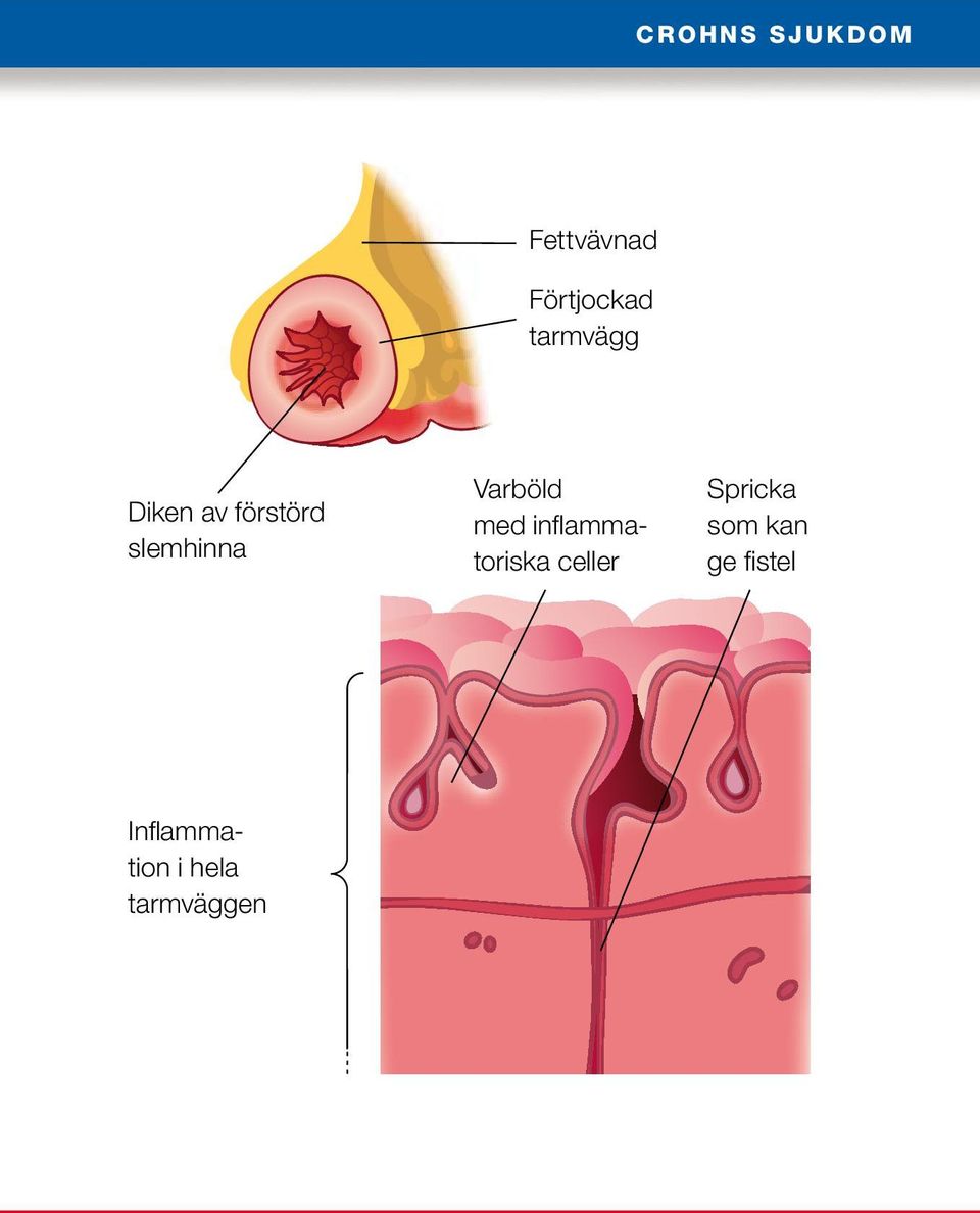 Varböld med inflammatoriska celler