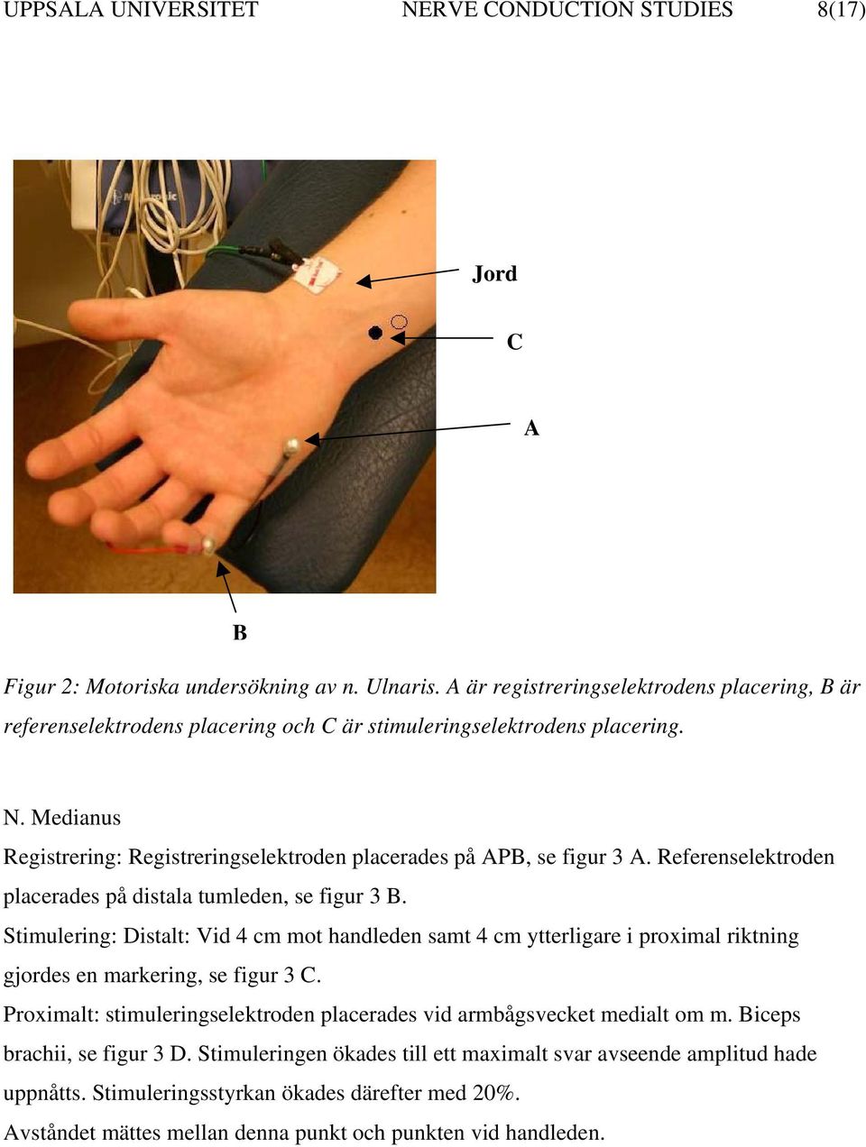 Medianus Registrering: Registreringselektroden placerades på APB, se figur 3 A. Referenselektroden placerades på distala tumleden, se figur 3 B.