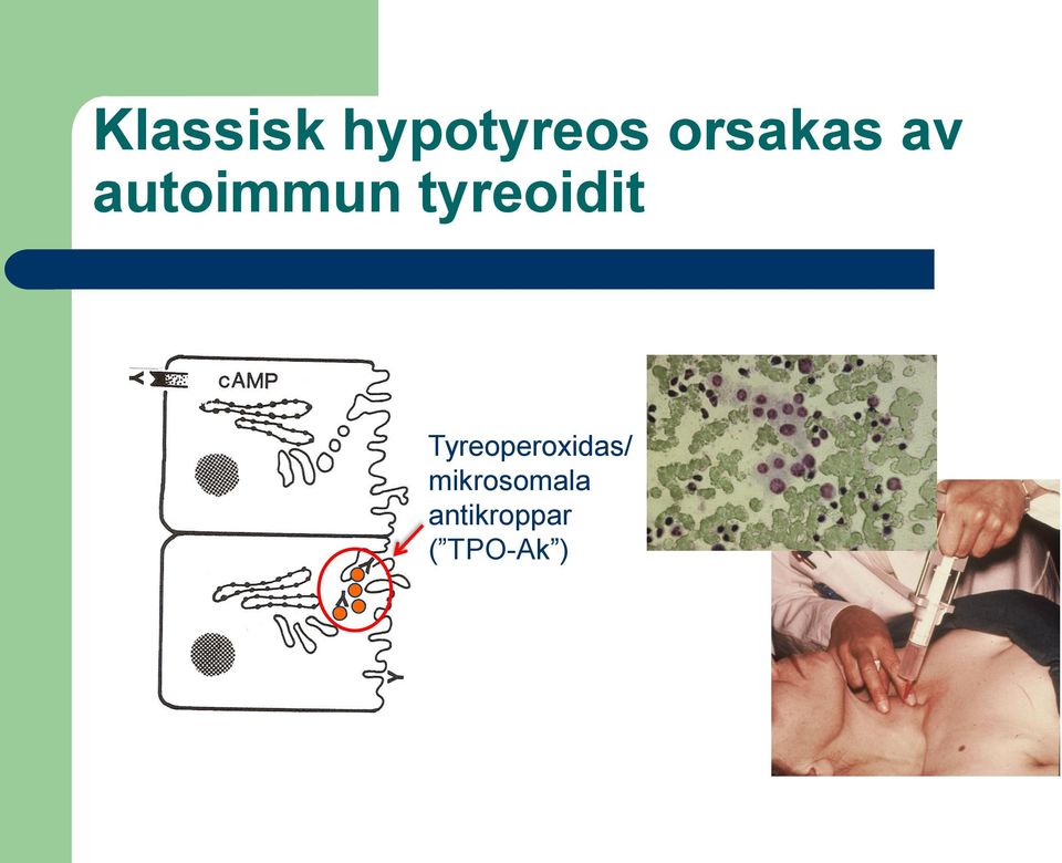 tyreoidit Tyreoperoxidas/