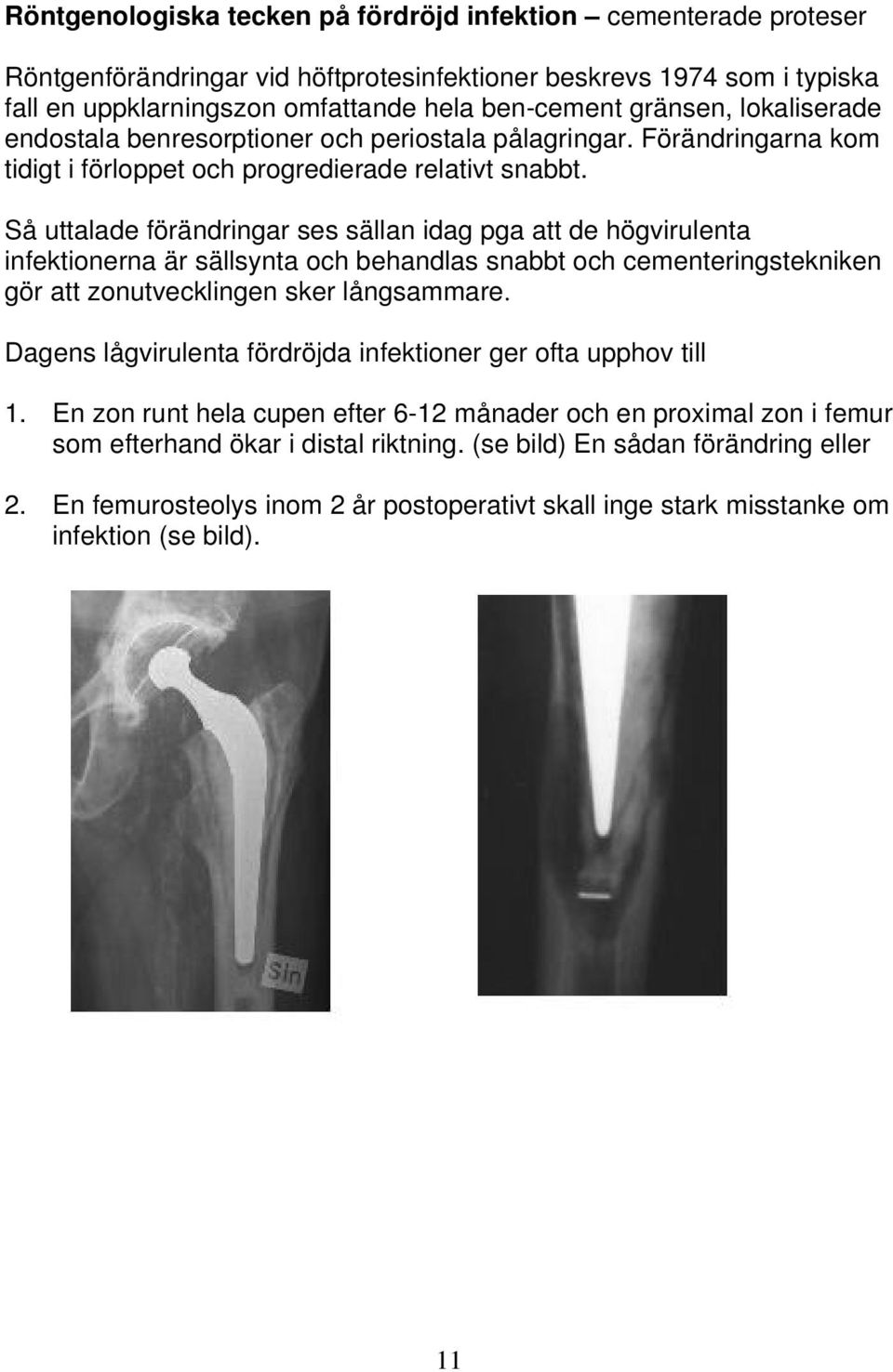 Så uttalade förändringar ses sällan idag pga att de högvirulenta infektionerna är sällsynta och behandlas snabbt och cementeringstekniken gör att zonutvecklingen sker långsammare.