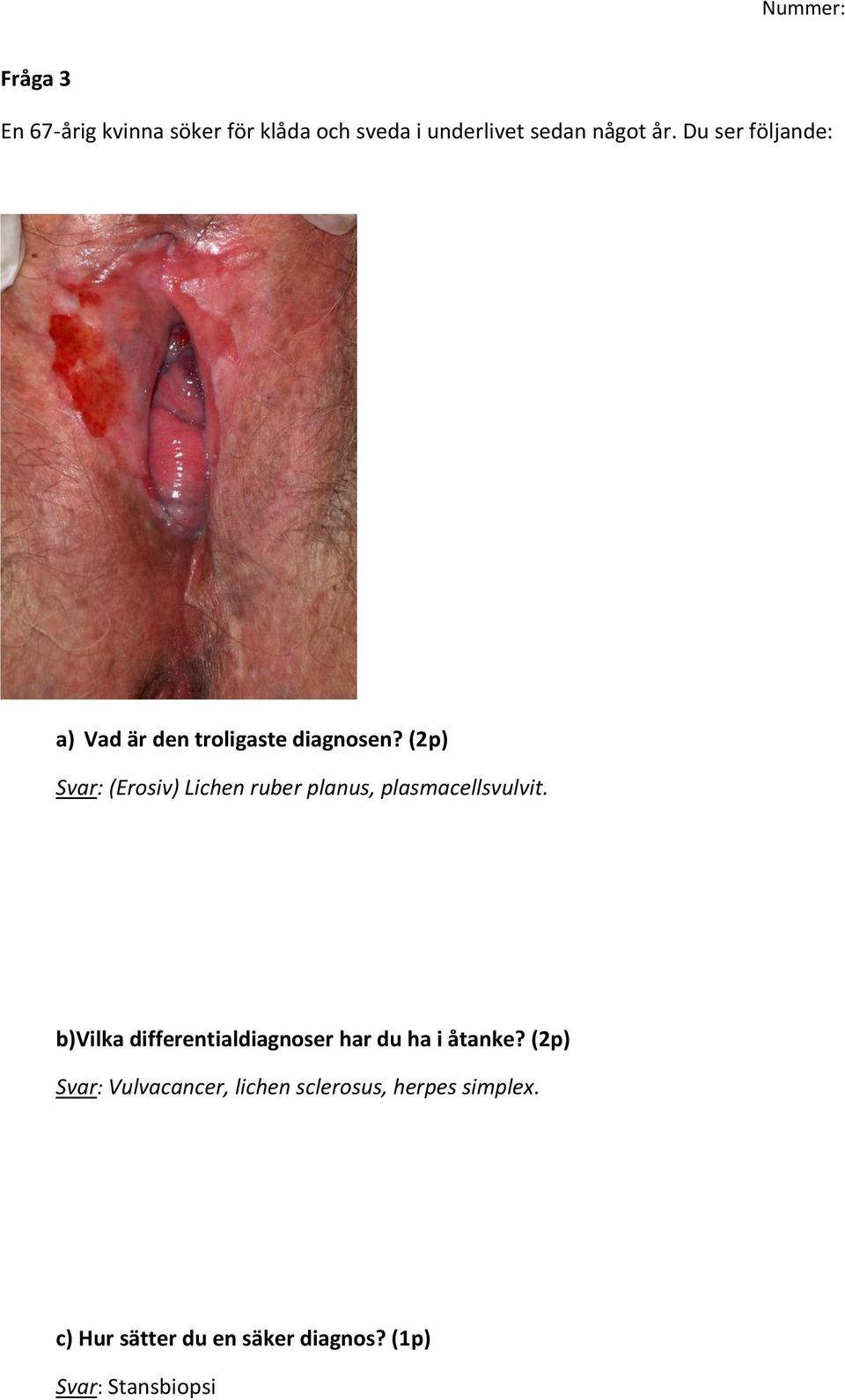 (2p) Svar: (Erosiv) Lichen ruber planus, plasmacellsvulvit.