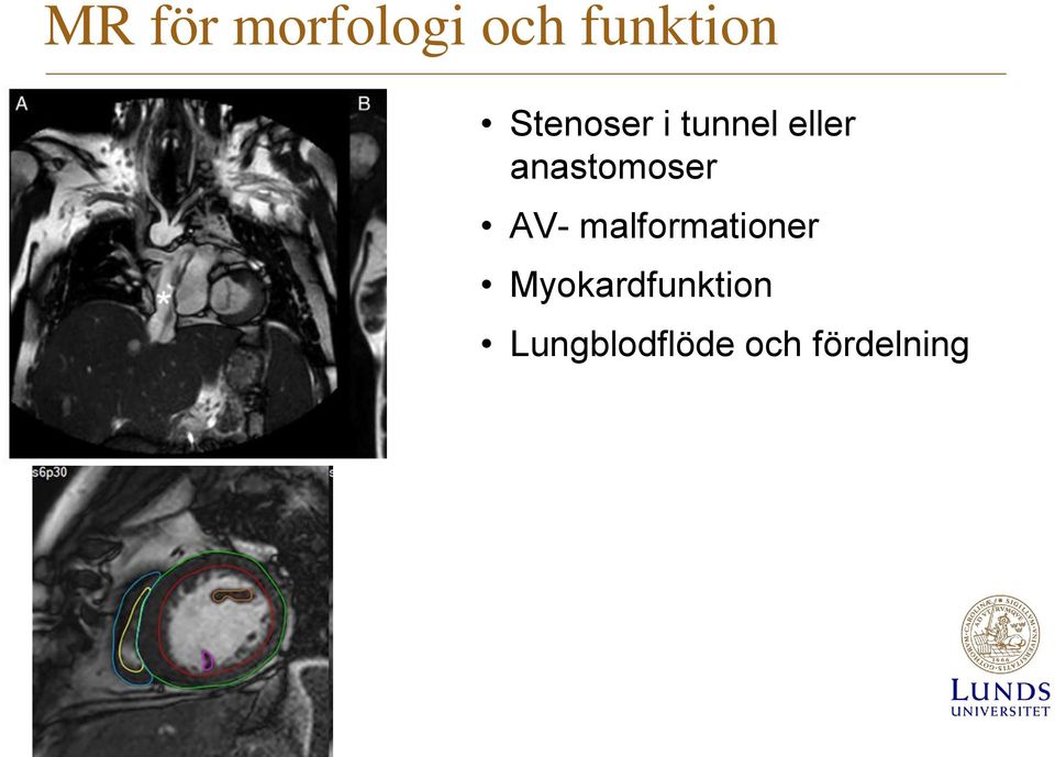 anastomoser AV- malformationer