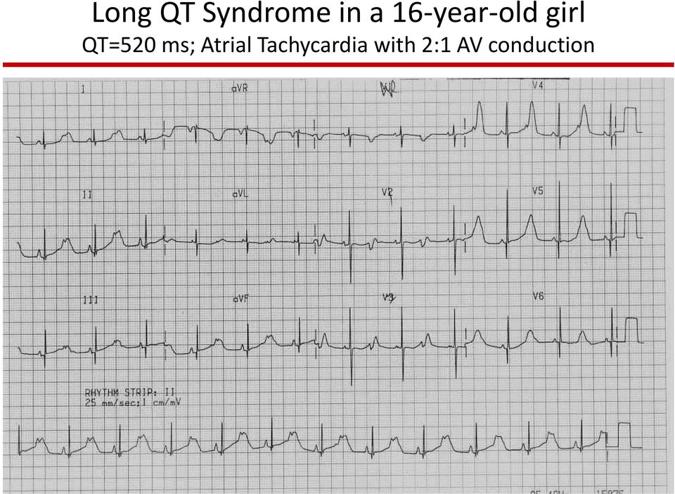 QT=520 ms; Atrial