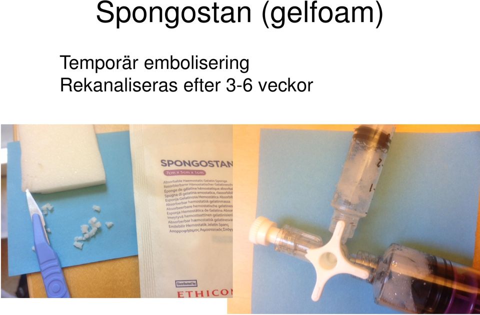 embolisering