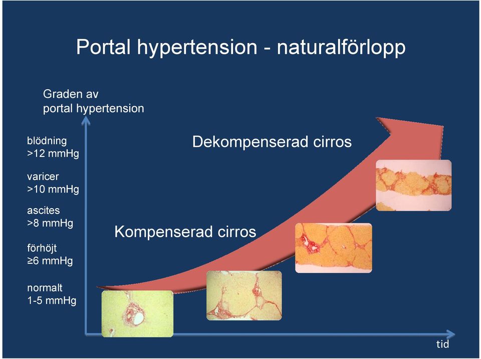 Dekompenserad cirros varicer >10 mmhg ascites >8