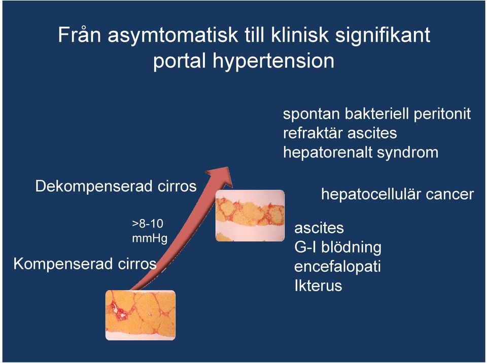 hepatorenalt syndrom Dekompenserad cirros >8-10 mmhg