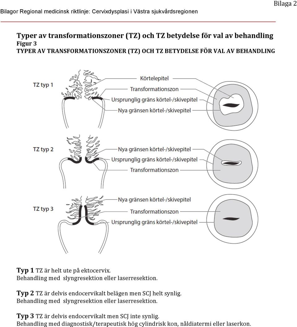 Behandling med slyngresektion eller laserresektion. Typ 2 TZ är delvis endocervikalt belägen men SCJ helt synlig.