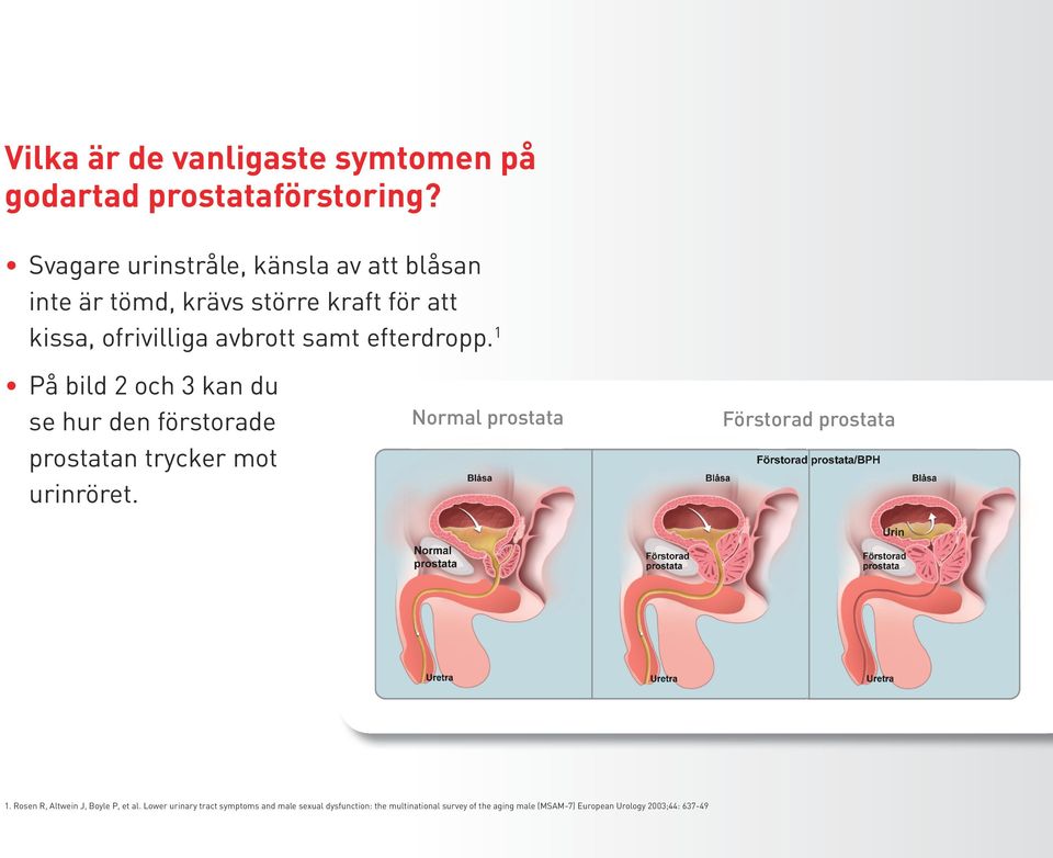 efterdropp. 1 På bild 2 och 3 kan du se hur den förstorade prostatan trycker mot urinröret.