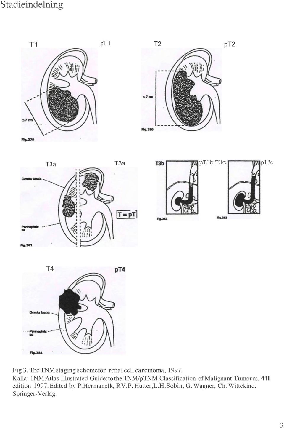 Illustrated Guide: to the TNM/pTNM Classification of Malignant Tumours.