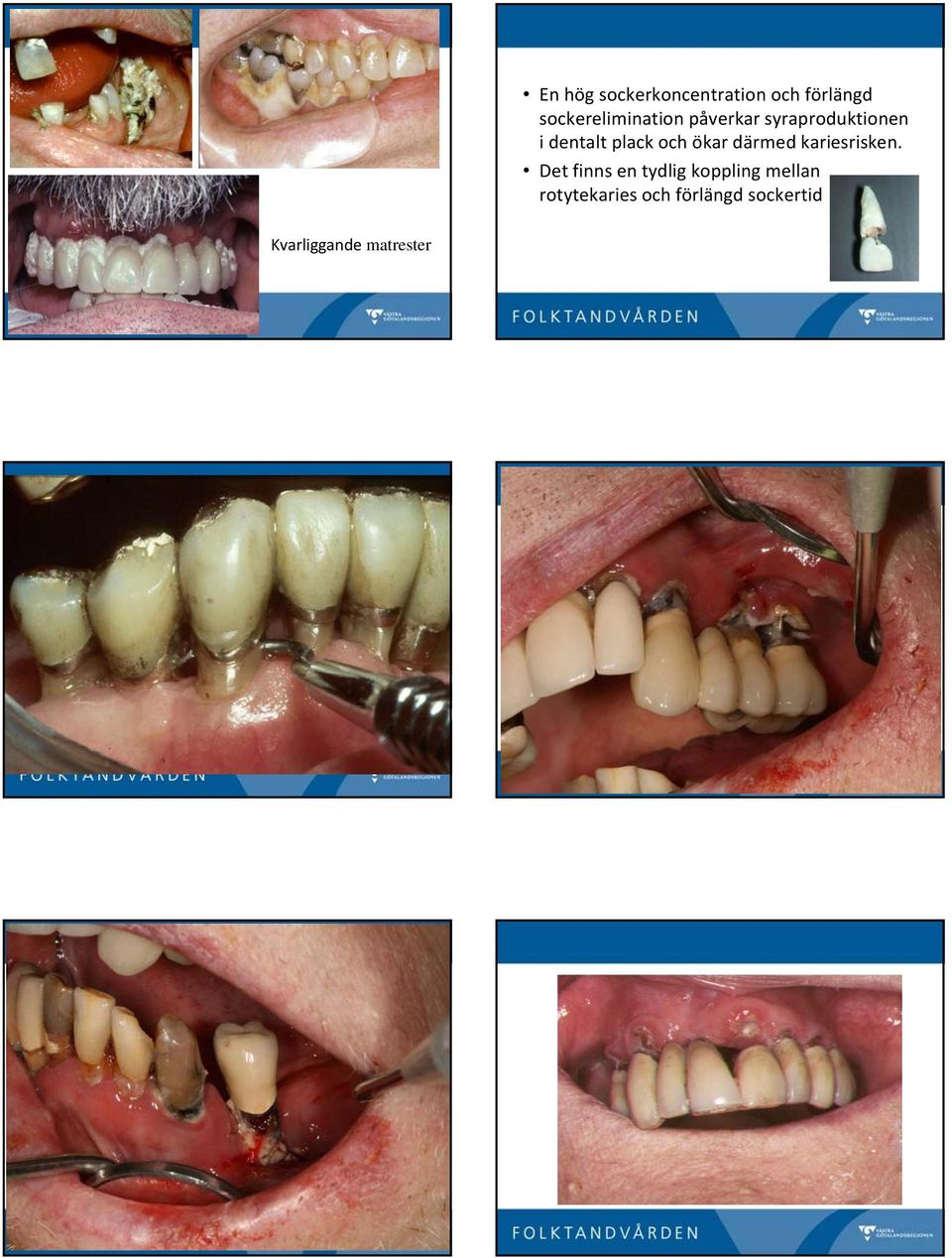 dentalt plack och ökar därmed kariesrisken.