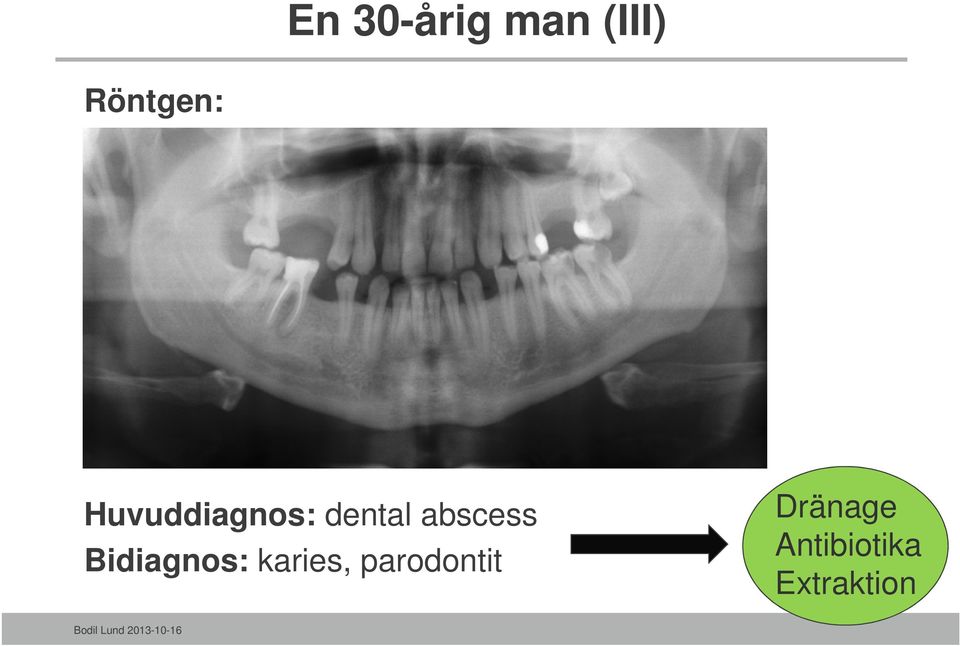 Bidiagnos: karies, parodontit